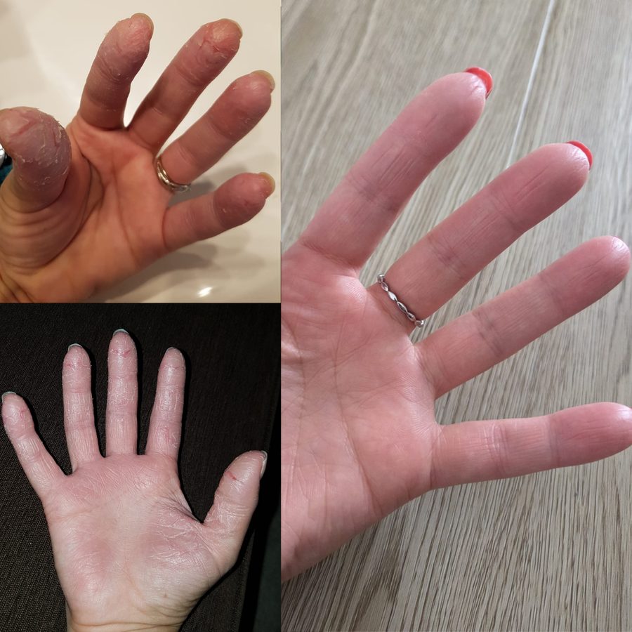 Marine, ses mains avant et après